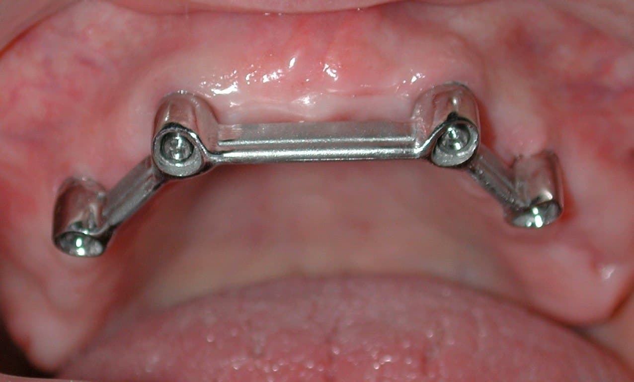 Prótesis sobre implantes en A Coruña